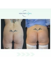 Butt Implants - HealTrip Global