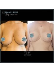 Breast Reduction - MayClinik Plastic Surgery