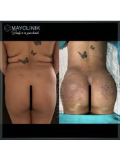 Butt Lift - MayClinik Plastic Surgery