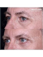 Eyelid Surgery - MayClinik Plastic Surgery