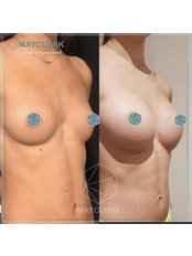 Breast Implants - MayClinik Plastic Surgery
