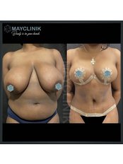 Tummy Tuck - MayClinik Plastic Surgery