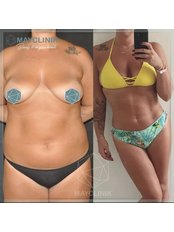 Liposuction - MayClinik Plastic Surgery