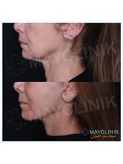 Neck Lift - MayClinik Plastic Surgery