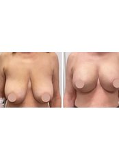 Breast Lift - Firma Clinic