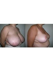 Breast Reduction - Op. Dr Alper Tuncel Estetik Plastik ve Rekonstrukt