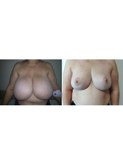 Breast Reduction - SurgeryTR - Istanbul