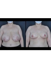 Breast Reduction - SurgeryTR - Istanbul