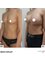 SurgeryTR - Istanbul - Breast Implant 