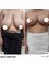 SurgeryTR - Istanbul - Breast Reduction 