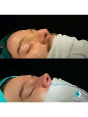 Nasal Tip Surgery - Assoc. Prof. Dr. Mehmet Emre Dinc - Istanbul Rhinoplasty Center