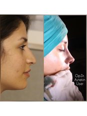 Open Rhinoplasty - Aytekin Uzer MD, Nose and Facial Plastic Surgery Clinic