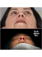 Alarplasty - Aytekin Uzer MD, Nose and Facial Plastic Surgery Clinic