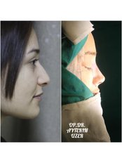 Closed Rhinoplasty - Aytekin Uzer MD, Nose and Facial Plastic Surgery Clinic