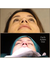 Open Rhinoplasty - Aytekin Uzer MD, Nose and Facial Plastic Surgery Clinic