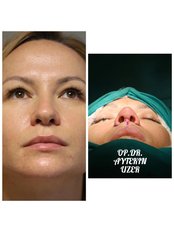 Nasal Tip Surgery - Aytekin Uzer MD, Nose and Facial Plastic Surgery Clinic