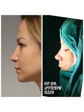 Nasal Tip Surgery - Aytekin Uzer MD, Nose and Facial Plastic Surgery Clinic