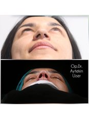 Alarplasty - Aytekin Uzer MD, Nose and Facial Plastic Surgery Clinic