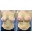 Db'est Clinic - Breast Uplift with Silicone Implant 