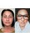 Dr Safa Manav - Facelift & Blepharoplasty 