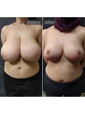 Breast Reduction - Dr Safa Manav