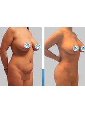 Liposuction - My Medi Expert