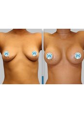 Breast Implants - My Medi Expert