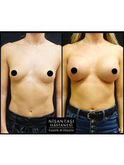 Breast Implants - Nisantasi Hospital