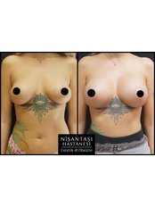 Breast Implants - Nisantasi Hospital