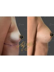 Breast Implants - Op. Dr Ahmet Arif Eroğlu