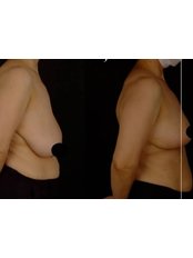Breast Reduction - Prof.Dr. Mustafa Keskin
