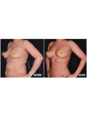 Liposuction - Quartz Clinique