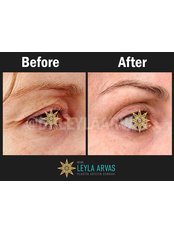 Eyelid Surgery - Quartz Clinique