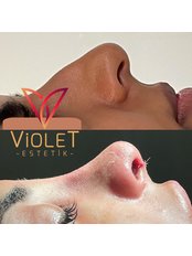 Lets reshape your nose with rinoplasty. Before and after of our patient is with you. If you are interested in a procedure ilke this you can contact us via Message or at - Violet Estetik