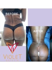 Lets reshape your body with #bbl. Before and after of our patient is with you. If you are interested in a procedure ilke this you can contact us via Message or at - Violet Estetik