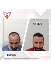 We would like to thank our patient for the photo of the first year after hair transplantation. If you are interested in this process, you can contact us via Message at - Violet Estetik