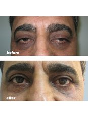 Eyelid Operation - SurgeryTR - Istanbul