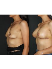 Breast Implants - SurgeryTR - Istanbul