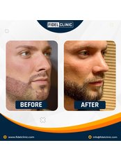 Beard Transplant - Fidel Clinic