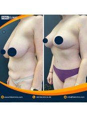 Breast Reduction - Fidel Clinic