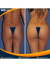 BBL - Brazilian Butt Lift - Fidel Clinic