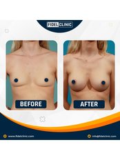 Breast Implants - Fidel Clinic
