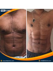 Abdominal Etching - Fidel Clinic