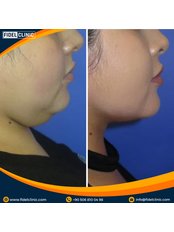 Neck Liposuction - Fidel Clinic