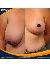 Breast Lift - Fidel Clinic