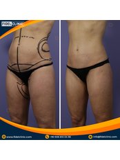 Liposuction - Fidel Clinic