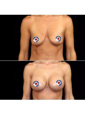 Breast Implants - Centrumedica