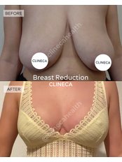 Breast Reduction - Clineca