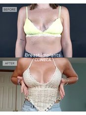 Breast Implants - Clineca