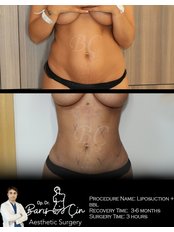 Liposuction - Dr. Baris Cin